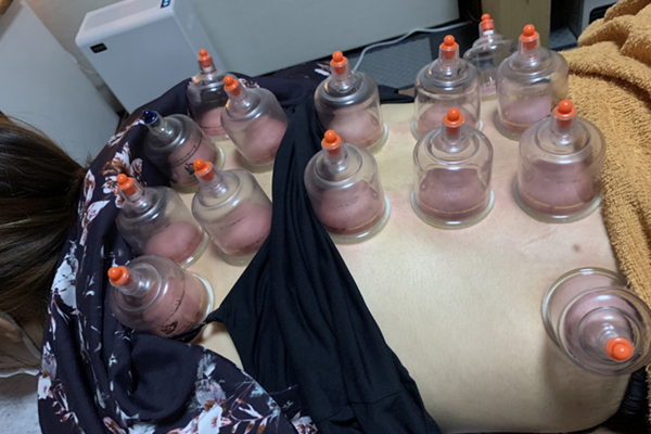 吸玉カッピング 施術後