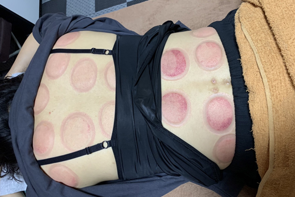 吸玉カッピング 施術中 ズーム