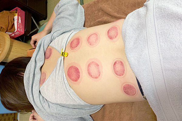 吸玉カッピング 施術中